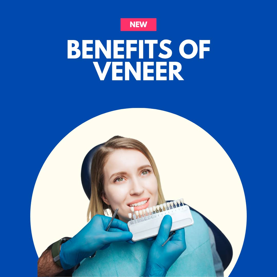 Benefits of Veneer
