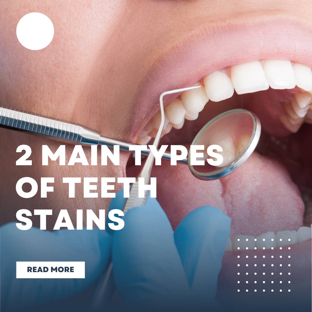 2 main types of teeth stain